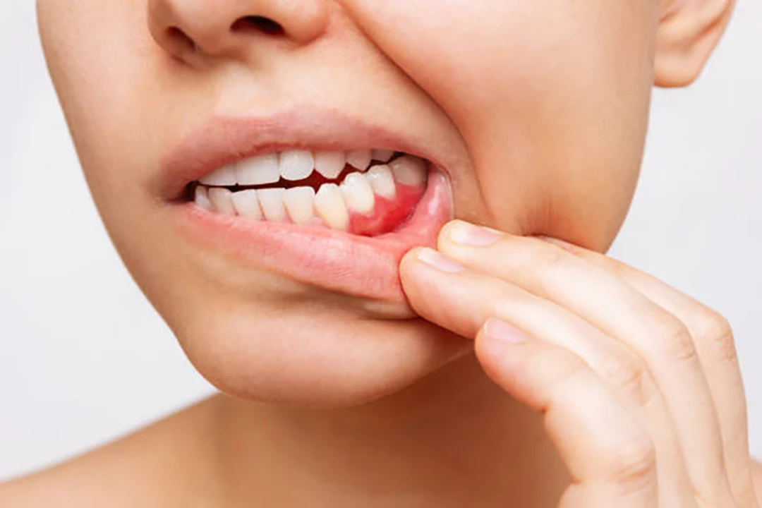 treating inflammation