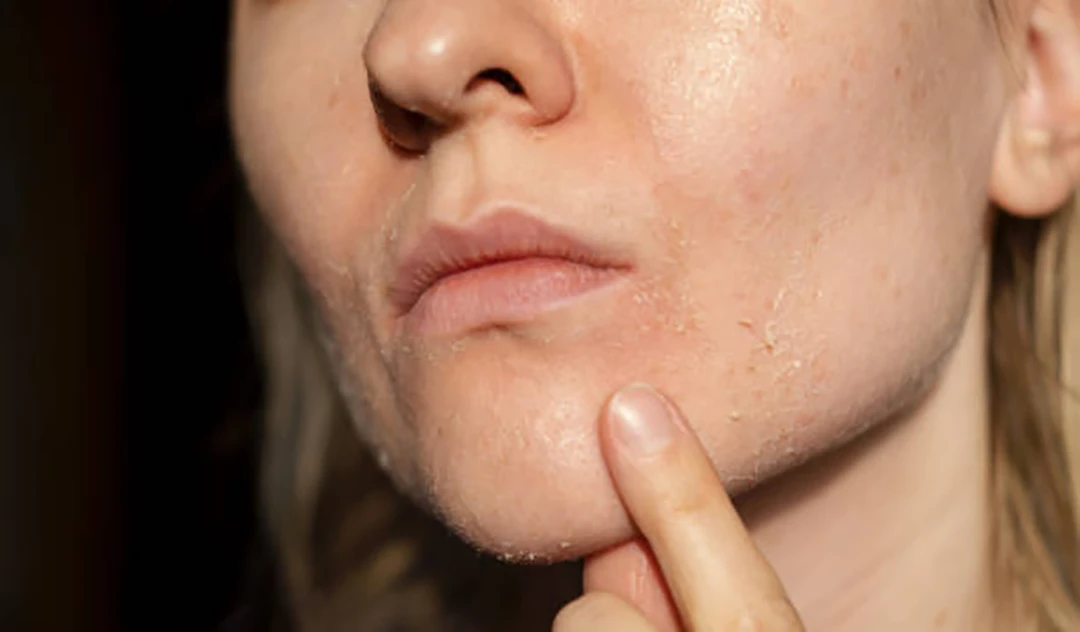 Types of dry skin disorders
