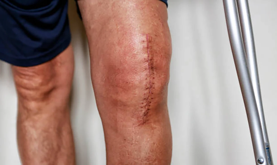 wound healing